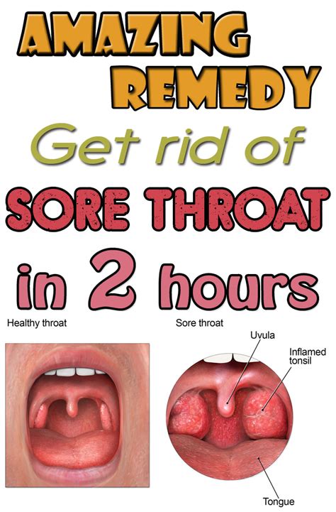 sore throat 의학용어